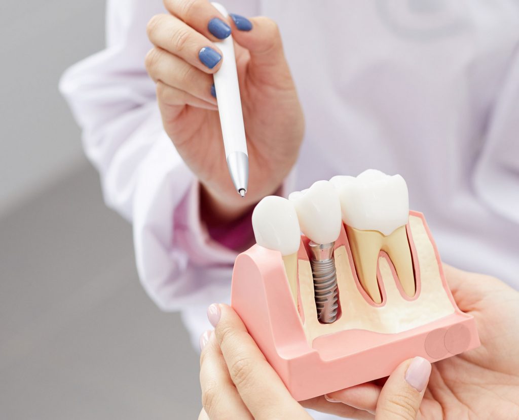 toothimplantation Core Dental Specialty Group